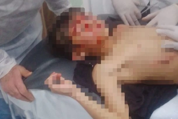 Menino é hospitalizado após ser atacado por Pitbull