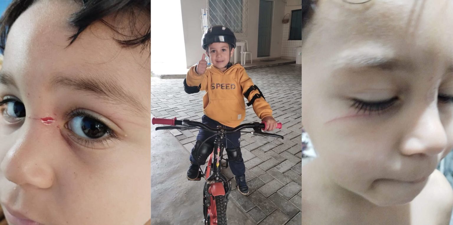 “Poderia ter ficado cego”: menino é ferido por linha de cerol em Balneário Camboriú