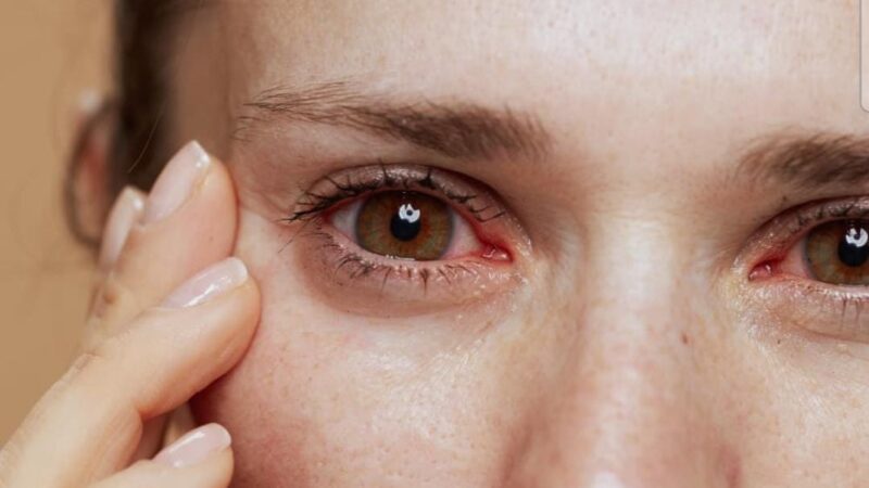 Sociedade Catarinense de Oftalmologia alerta para alergias oculares na primavera