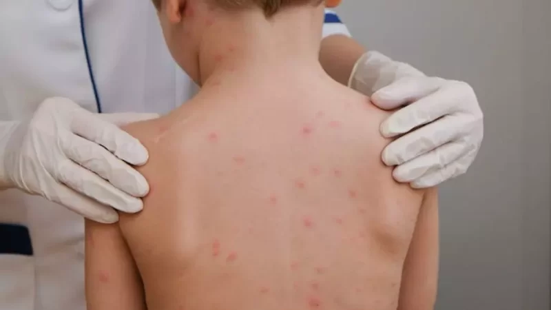 Cidade catarinense confirma caso de meningite bacteriana em criança