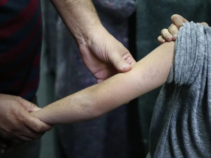 Creche em Minas Gerais suspende aulas após casos suspeitos de sarna humana