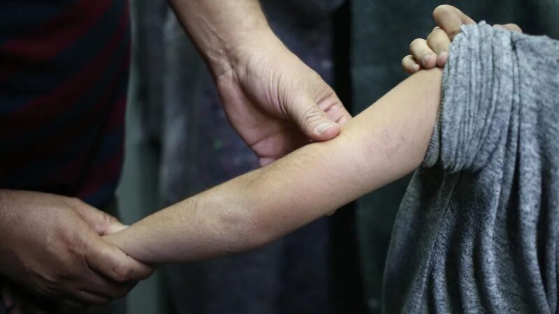 Creche em Minas Gerais suspende aulas após casos suspeitos de sarna humana