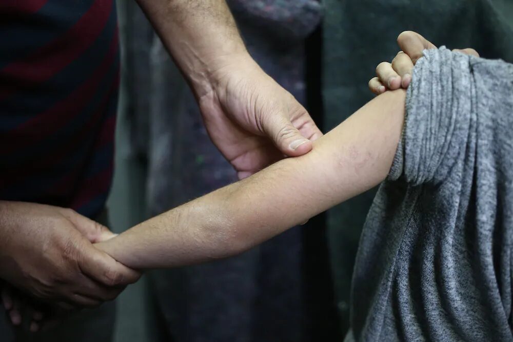Creche em Minas Gerais suspende aulas após casos suspeitos de sarna humana