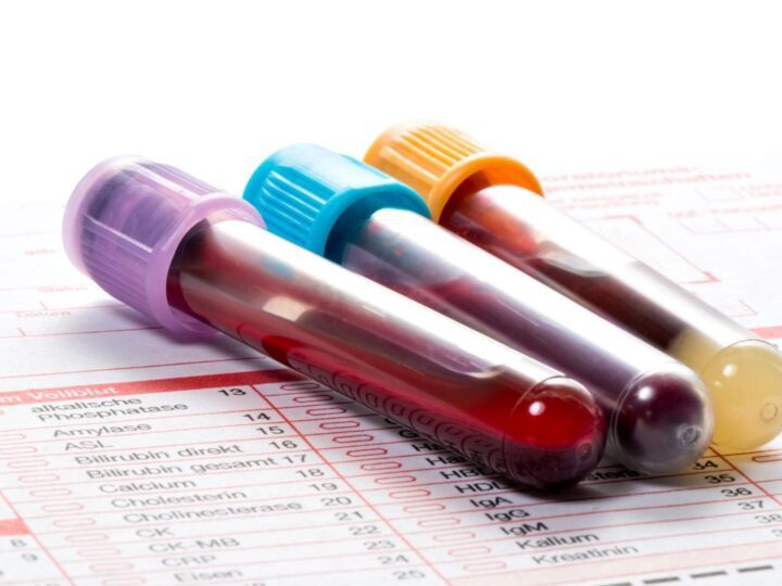 Novo exame de sangue para detectar mais de 50 tipos de câncer chega ao Brasil