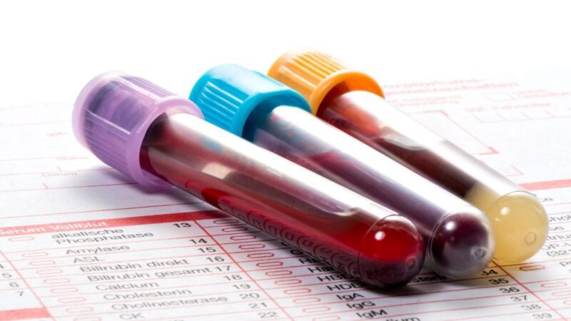Novo exame de sangue para detectar mais de 50 tipos de câncer chega ao Brasil